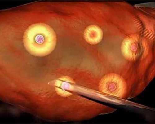 国内地贫捐卵联系,供卵试管婴儿的适应症有哪些