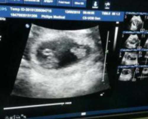 国内借卵代怀,IVF治疗中降调节形成大卵泡后，可以直接穿刺取卵吗？